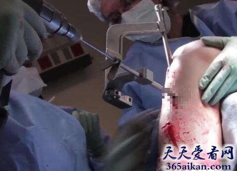 最恐怖的手术：断骨增高手术，分分钟敲断你双腿！