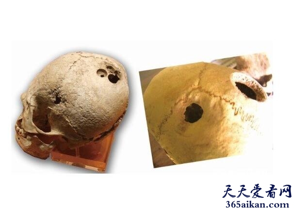 医学神迹：中国5000年前就有开颅手术