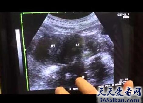 双子宫双阴道真的存在？台湾双子宫双阴道女人成功生下双胞胎
