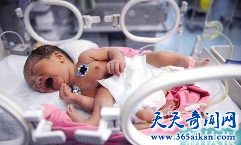惠州新生儿罕见畸形长4手4脚，父母跑遍大小医院！