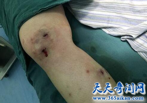 上海女子水中探险感染寄生虫，腿部挖出活虫！