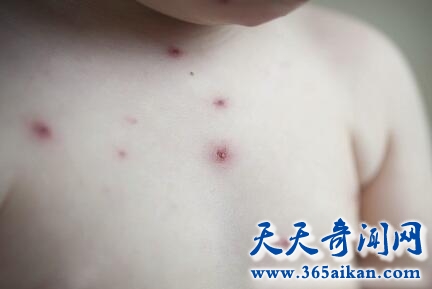 得了小儿病毒性疱疹该怎么办？儿童病毒性疱疹有什么症状？