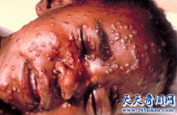 天花病毒2.jpg
