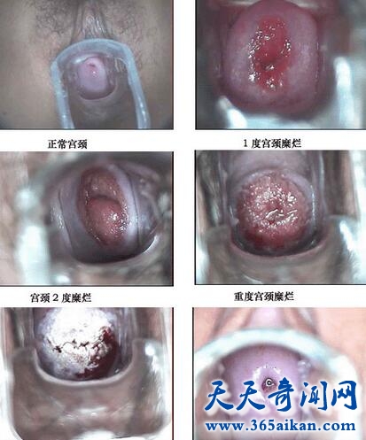 宫颈糜烂原因是什么？引起宫颈糜烂的原因有哪些