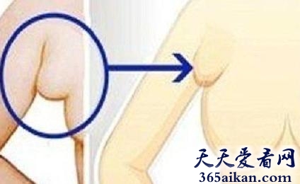 世界上乳房最多的人，女子腋窝莫名长出4个肉团竟都是乳房副乳