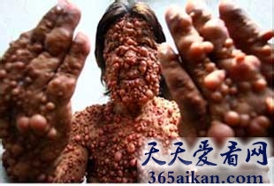 世界上最“恐怖的人类”，印尼男子全身长可怕肿瘤被称“泡泡人”