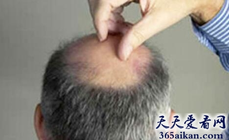 梦见掉发秃顶是什么意思?梦见掉发秃顶预示着什么?