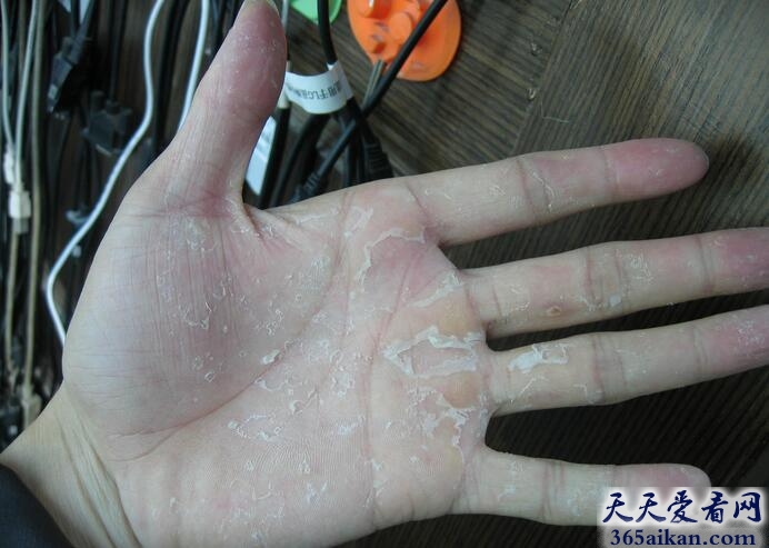 梦见脱皮好不好？梦见脱皮预示着什么？