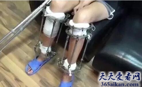 断骨增高手术2.jpg