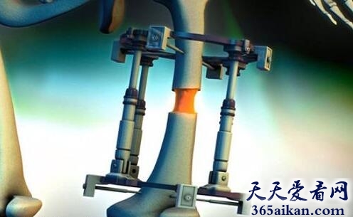 断骨增高手术3.jpg