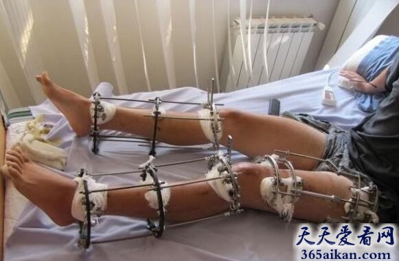 断骨增高手术4.jpg