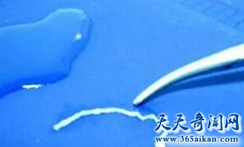 女生腹部取出活虫1.jpg