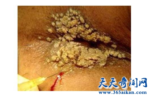 hpv3.jpg