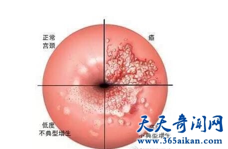 hpv7.jpg