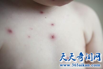 小儿病毒性疱疹1.jpg