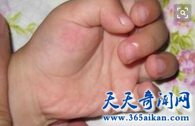 病毒性疱疹2.jpg