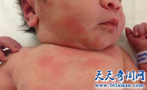 病毒性疱疹4.jpg