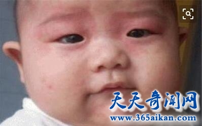 病毒性疱疹3.jpg