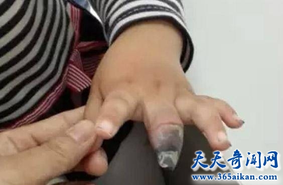 生活中的医疗小知识，创可贴使用不当威胁健康