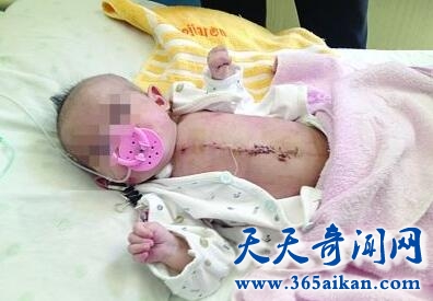 生命的奇迹，医生将婴儿裸露体外的心脏塞回体内！